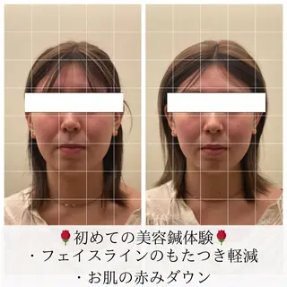 美容鍼/ヘッドスパ/ 💎さかもとのエステ・リラクイメージ