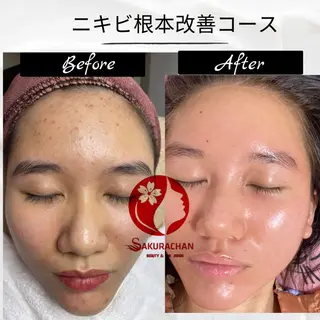 ニキビ、痩身、脱毛、 サクラチャンスパのエステ・リラクイメージ