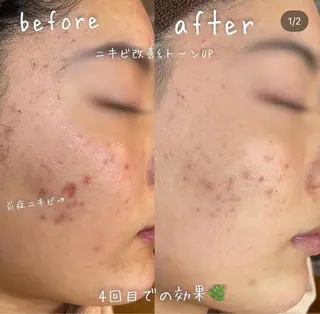 【ハーブピーリング/毛穴洗浄】NA skin 川崎店〜ニキビ・毛穴専門店〜所属・NAskin川崎 皆川のエステ・リラクイメージ