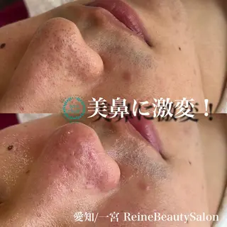 Reine BeautySalon所属・毛穴/シミ肝斑/脱毛 横山梨里のエステ・リラクイメージ