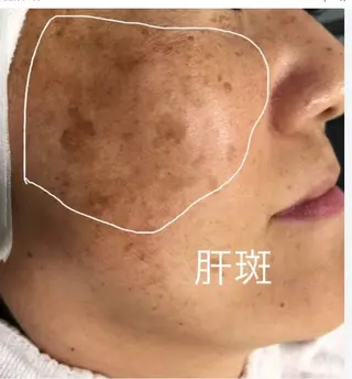 ☺ハーブピール💕 ソフィアカロン💖のエステ・リラクイメージ