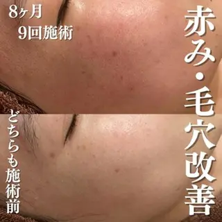 🔥3か月で肌革命 🔥ニキビ専門店のエステ・リラクイメージ