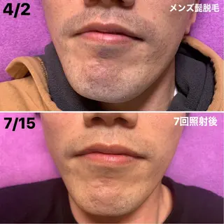 メンズ 脱毛＆エステサロン【アンリミット】所属・森谷 莉美のエステ・リラクイメージ