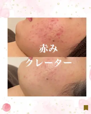 ニキビ跡専門サロン Ainaのエステ・リラクイメージ