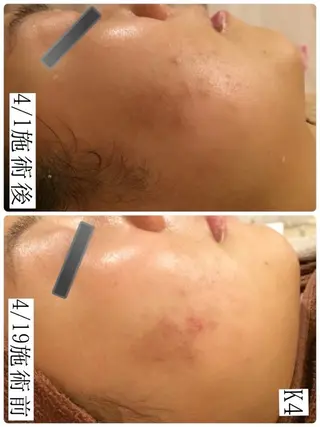 学生ニキビ改善🍀 優しい肌質改善のエステ・リラクイメージ