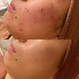 ダウンタイムなし✨ 敏感肌さん用エステのエステ・リラクイメージ