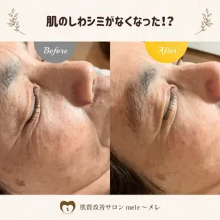 ニキビケア/毛穴/ 赤み/自信の肌✨森園のエステ・リラクイメージ