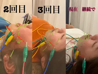 美容鍼灸Solana所属・肌質改善×美容鍼 ゆいのエステ・リラクイメージ