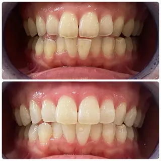 White Berry SELF BEAUTY SALON所属・セルフホワイトニング 🦷口元垢抜け✨のその他イメージ