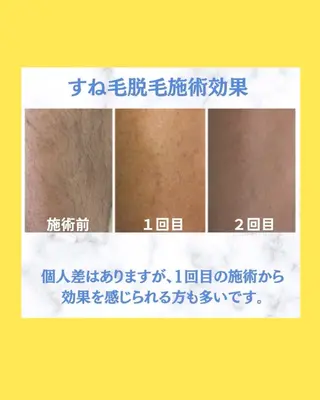 ヘアサロンLISALISA所属・セルフ脱毛・光エステ LISALISAのエステ・リラクイメージ