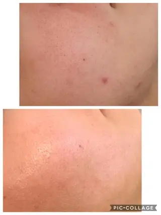 ニキビ/肌質改善専門 Snow skinのエステ・リラクイメージ