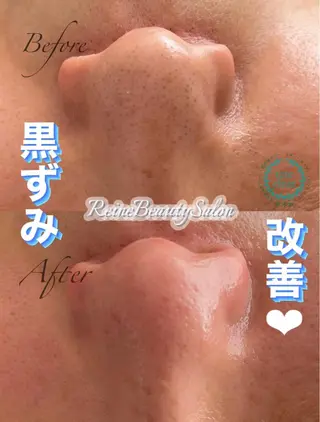 Reine BeautySalon所属・毛穴/シミ肝斑/脱毛 横山梨里のエステ・リラクイメージ
