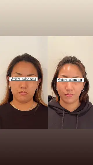 美容鍼灸サロン　TIARA所属・鍼灸サロン TIARA　美容鍼のエステ・リラクイメージ