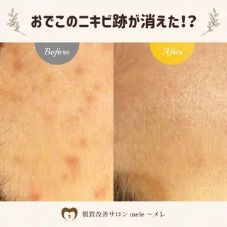 ニキビケア/毛穴/ 赤み/自信の肌✨森園のエステ・リラクイメージ