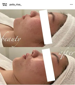 毛穴/ピーリング ララピール/POLAのエステ・リラクイメージ