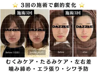 美容鍼DAZZLE マスザキのエステ・リラクイメージ