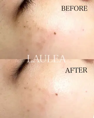 シミケア/ハーブピーリング/脱毛/小顔フェイシャル/ハーブ温浴　LAULEA所属・素肌をキレイに ラウレア🌼Hayaのエステ・リラクイメージ