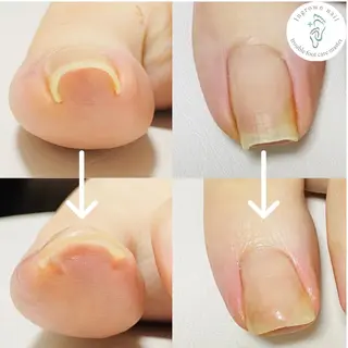 ネイル 深爪・巻き爪 専門サンセリテのネイルデザイン