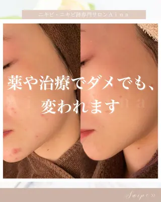 セミロング カラー パーマ ヘアアレンジ メンズ キッズ ネイル マツエク・マツパ アイブロウ ニキビ跡専門サロン Ainaのエステ・リラクイメージ