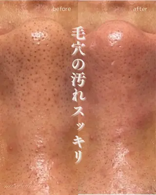 肌質改善×毛穴洗浄 ナスサロ 看護師只野のエステ・リラクイメージ