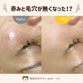 ニキビケア/毛穴/ 赤み/自信の肌✨森園のエステ・リラクイメージ