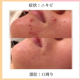 皮膚科より効果あり ⁉️最短ニキビ改善のエステ・リラクイメージ