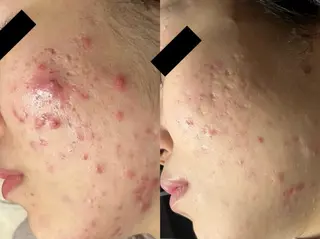 肌質改善ハーブ ピーリングBellaのエステ・リラクイメージ