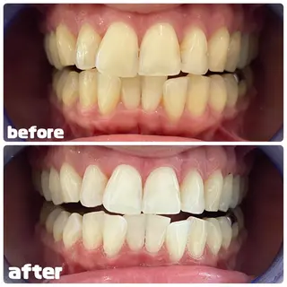 White Berry SELF BEAUTY SALON所属・セルフホワイトニング 🦷口元垢抜け✨のその他イメージ