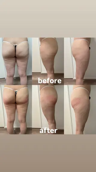 Miiju.所属・Miiju. 石巻市 脂肪冷却  鈴木のエステ・リラクイメージ