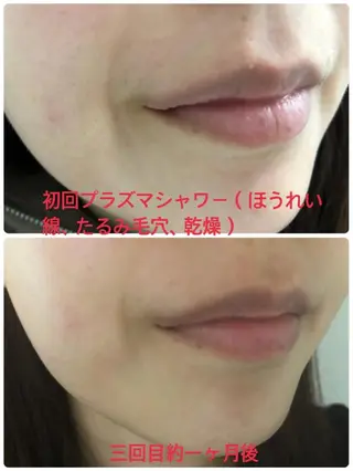 ハイフ リンパ 毛穴 ダフネ 六本木のエステ・リラクイメージ
