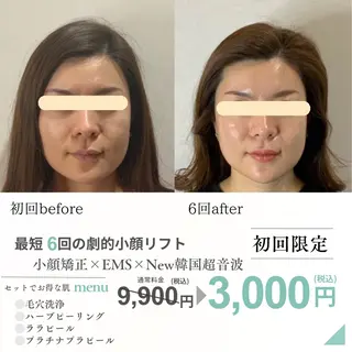 最速小顔・肌質管理 ❣️エスポワールのエステ・リラクイメージ
