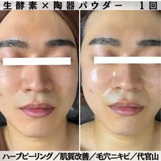 【ハーブピーリング/韓国ツヤ肌ピーリング】RelierBelle-ルリエベル-所属・肌質改善/肌育特化 プライベートサロンのエステ・リラクイメージ