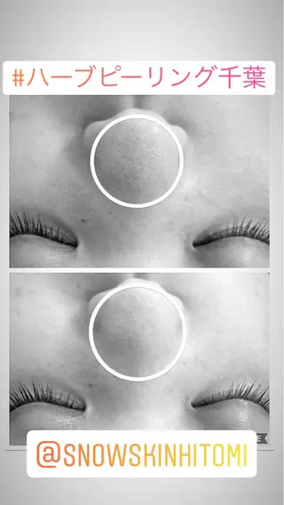 ニキビ/肌質改善専門 Snow skinのエステ・リラクイメージ