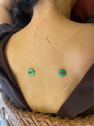 Acupuncture  salon LINOA リノア鍼灸院所属・LINOAヘッドスパ 小顔ケア/逆子ケアのエステ・リラクイメージ
