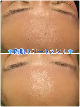 【リベルハーブピーリング認定店】敏感肌・美白脱毛専門店Dione立川店所属・Dione 立川店のエステ・リラクイメージ