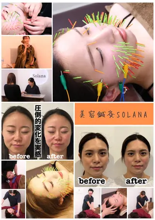 美容鍼灸Solana所属・肌質改善×美容鍼 ゆいのエステ・リラクイメージ
