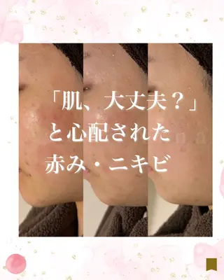 ニキビ跡専門サロン Ａｉｎａのエステ・リラクイメージ