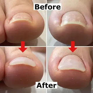 ネイル Mellow nail所属・巻爪無料モデル募集 ✨🦶MEGUMIのネイルデザイン