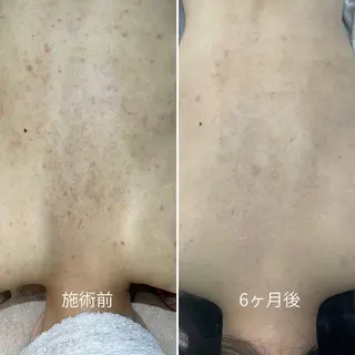 シェノン所属・ニキビ・毛穴改善 専門サロンのエステ・リラクイメージ