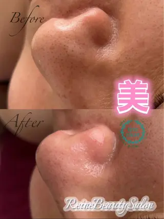 Reine BeautySalon所属・毛穴/シミ肝斑/脱毛 横山梨里のエステ・リラクイメージ