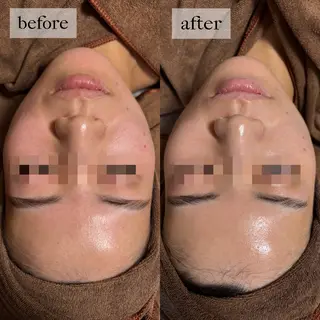 HINANO矢場町店【ヒナノ】所属・脱毛/肌改善🌿 HINANO 村田のエステ・リラクイメージ