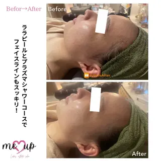 Meupニキビ専門店 背中/ハーブ/ララのその他イメージ