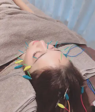 即小顔♥️美容鍼× ハーブピーリングのその他イメージ