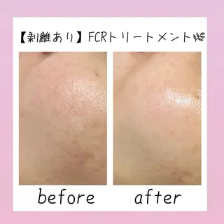 肌質改善Charme coco  みさのエステ・リラクイメージ