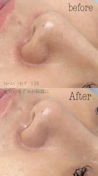 肌質改善|美眉サロンCannone'所属・肌質改善|美眉サロン Cannone’の眉毛・アイブロウイメージ