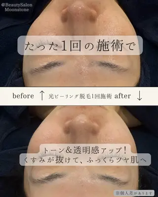 Beauty Salon Moonstone所属・Moonstone 男女•キッズ脱毛のエステ・リラクイメージ