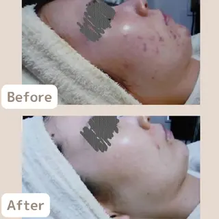 レチノール/ニキビ/ 毛穴ケア 浅川のエステ・リラクイメージ