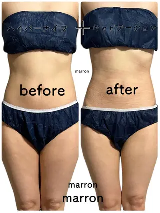 marron所属・痩身ハイパーナイフ ララピールリアボーテのエステ・リラクイメージ