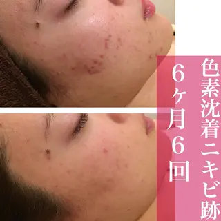 学生ニキビ改善🍀 優しい肌質改善のエステ・リラクイメージ