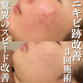 🔥3か月で肌革命 🔥ニキビ専門店のエステ・リラクイメージ